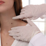 Skin Tag Removal Treatments in Cardiff