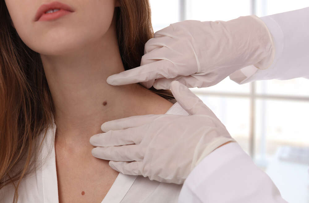 Skin Tag Removal Treatments in Cardiff