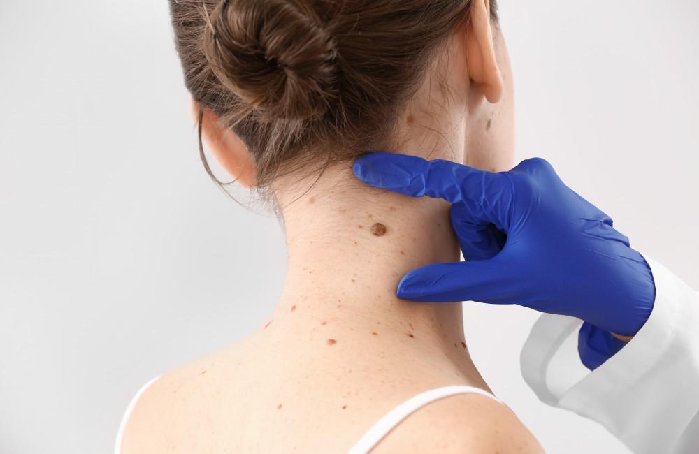 Skin Tag Removal Treatments in Cardiff